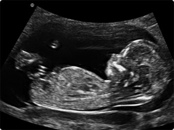 12 week ultrasound down syndrome pictures